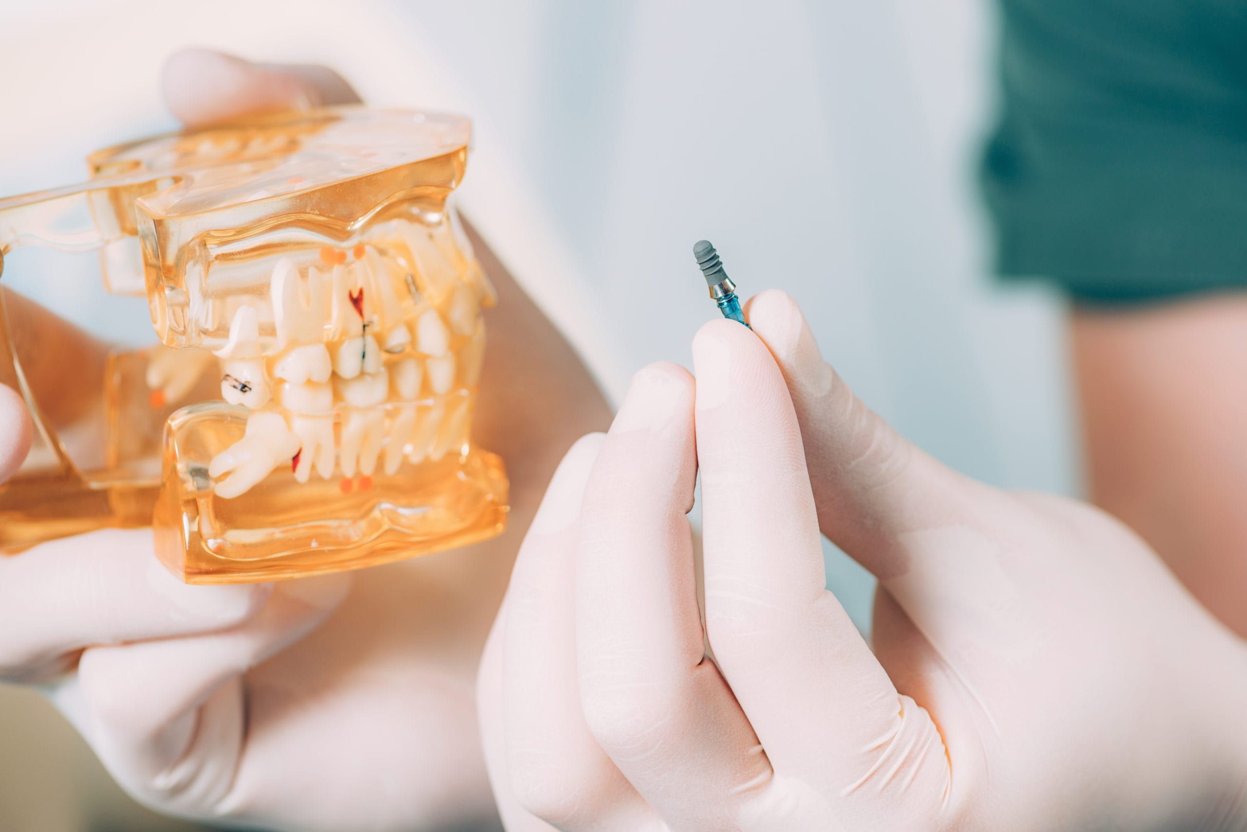 Dental implants in Houston