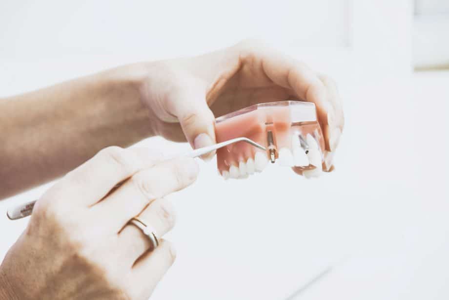 Costo de implantes dentales