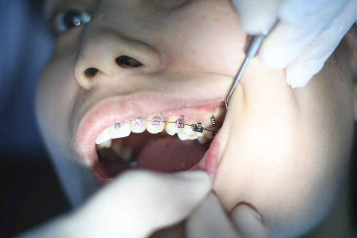 Dental Braces and It's types, Braces cost and braces treatment in Houston