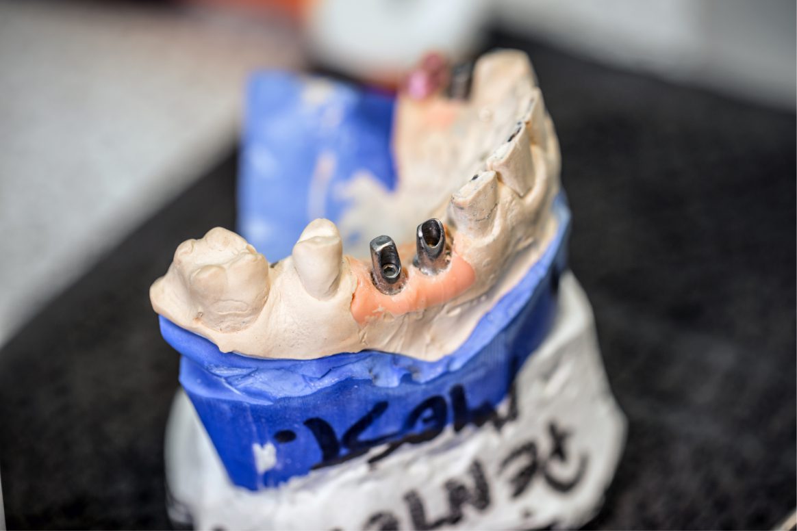 Implantes dentales en Houston 2